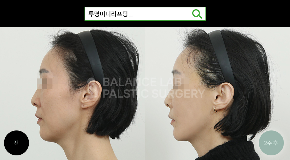 Before 4 Side