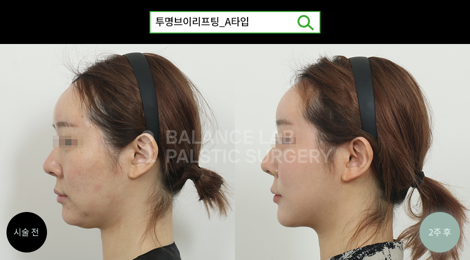 Before 3 Side