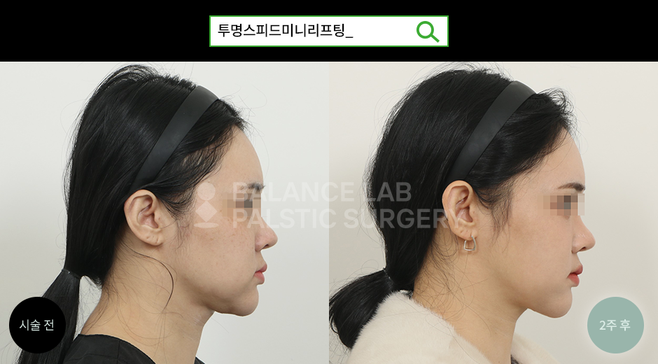 Before 2 Side