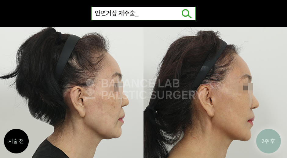 Before 2 Side
