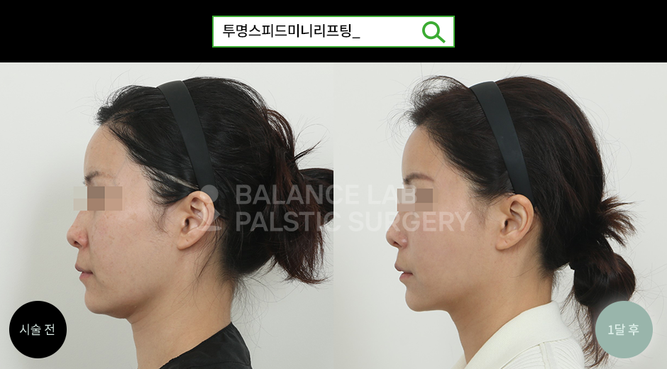 Before 3 Side