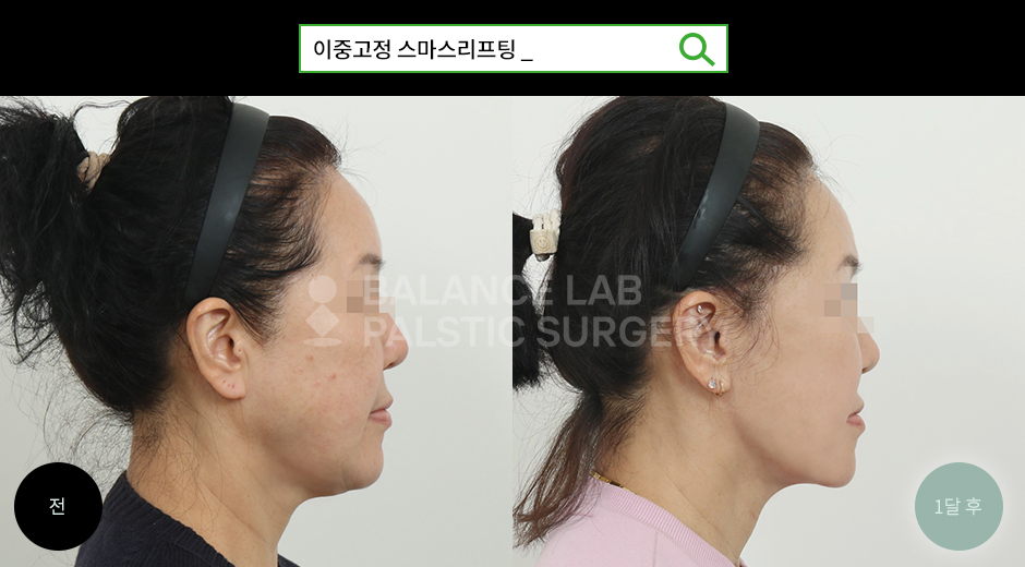 Before 2 Side