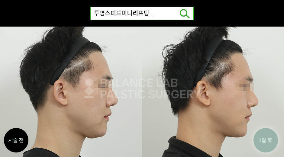 Before 4 Side