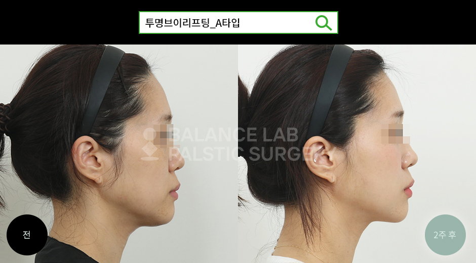Before 3 Side