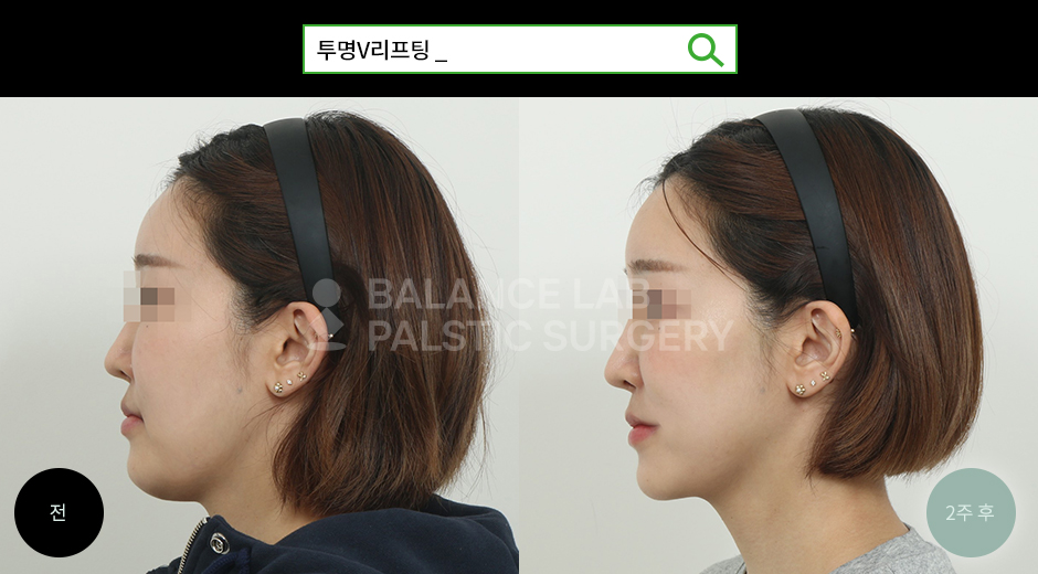 Before 2 Side