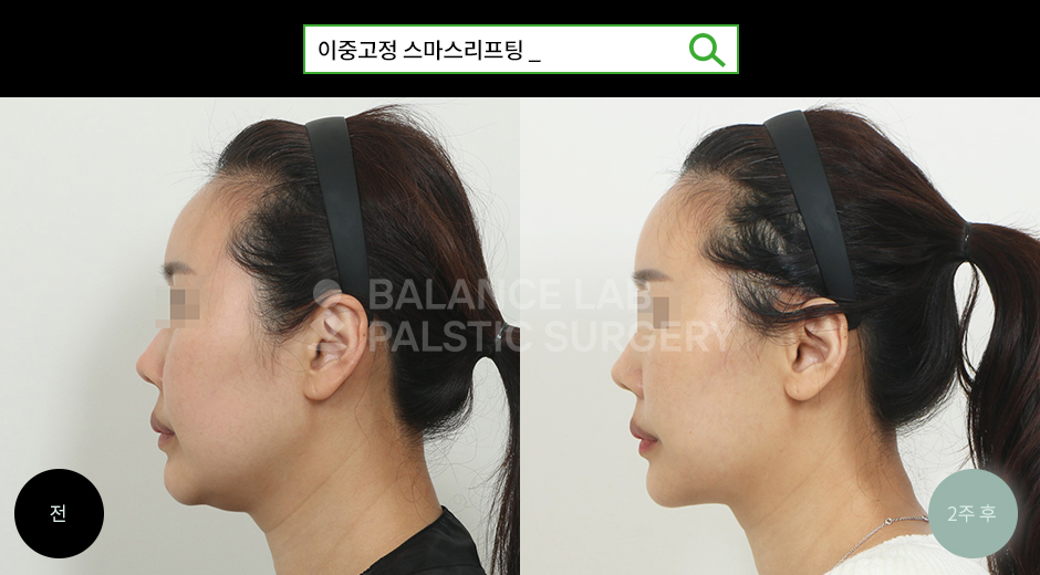 Before 2 Side