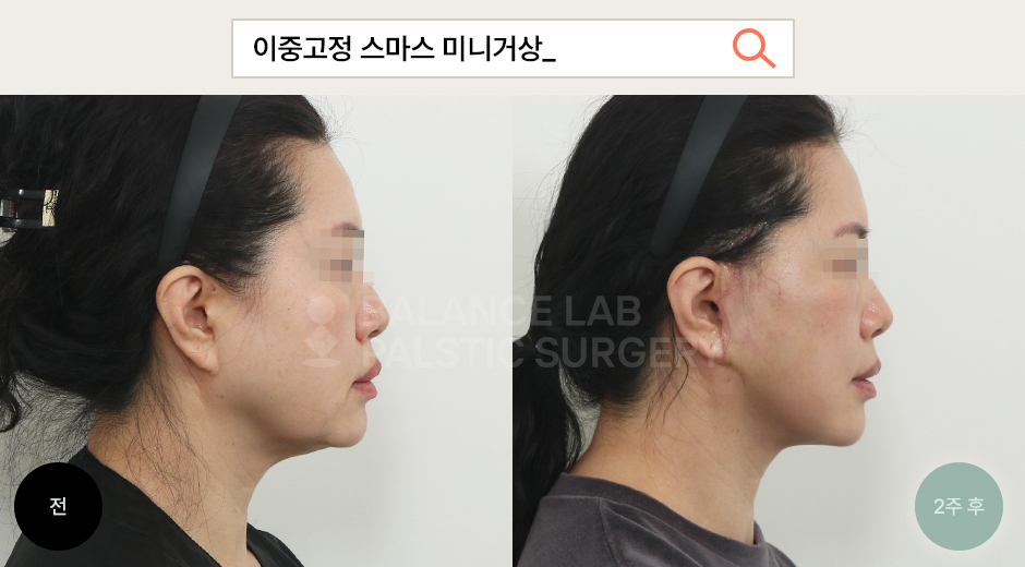 Before 2 Side