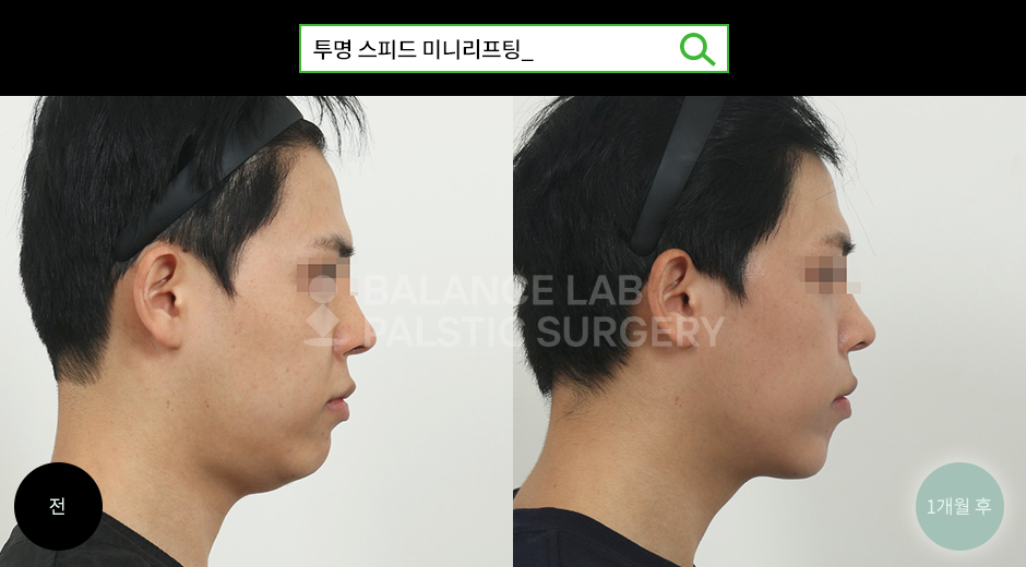 Before 3 Side