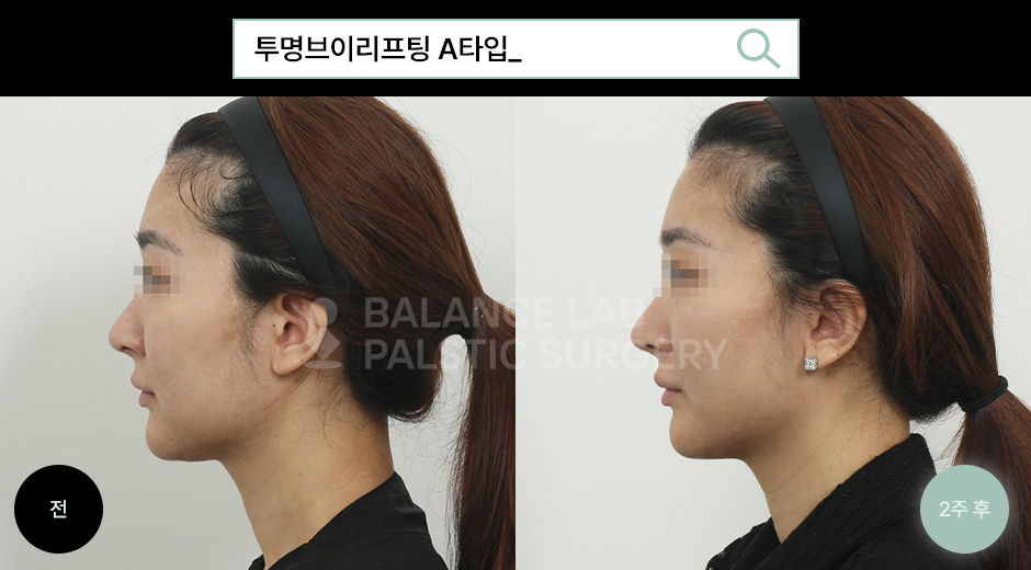 Before 2 Side