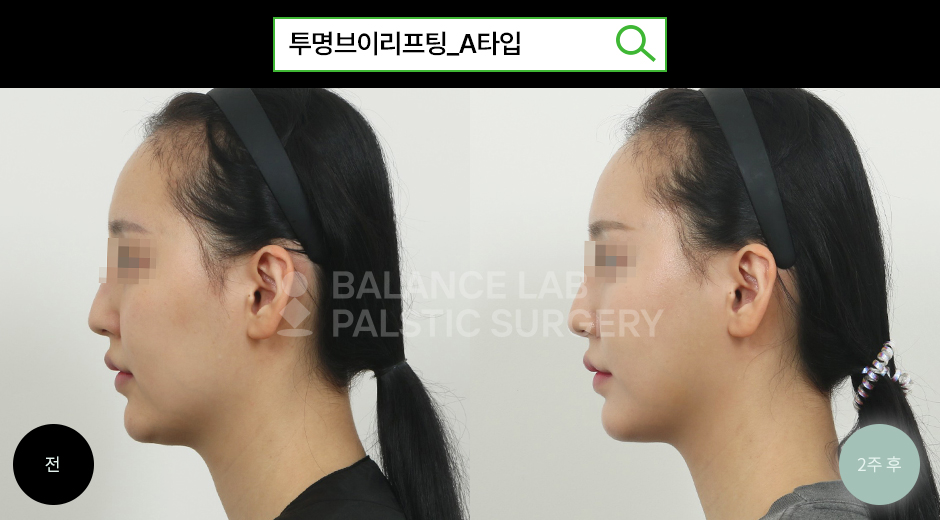 Before 2 Side