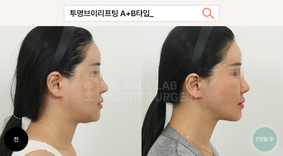 Before 2 Side