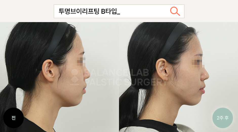 Before 4 Side