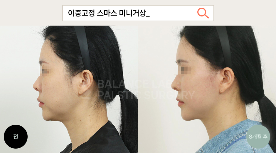 Before 2 Side
