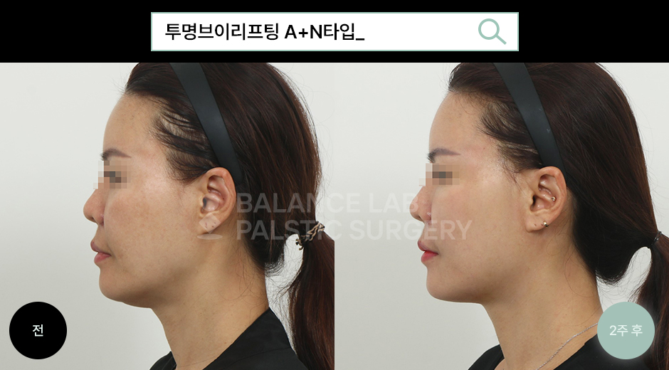 Before 3 Side