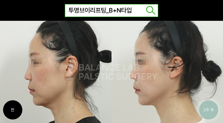 Before 3 Side