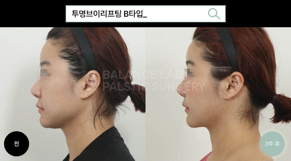 Before 2 Side