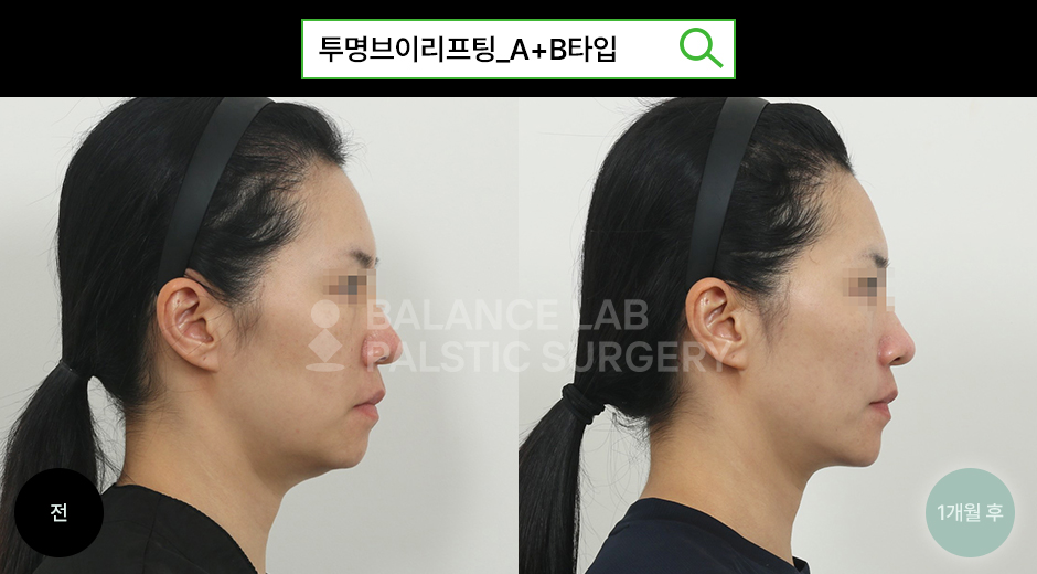 Before 3 Side