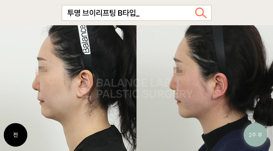 Before 3 Side