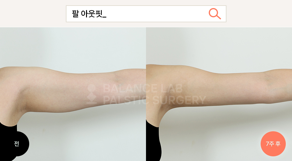 Before 4 Side