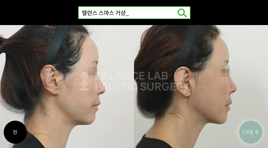 Before 2 Side