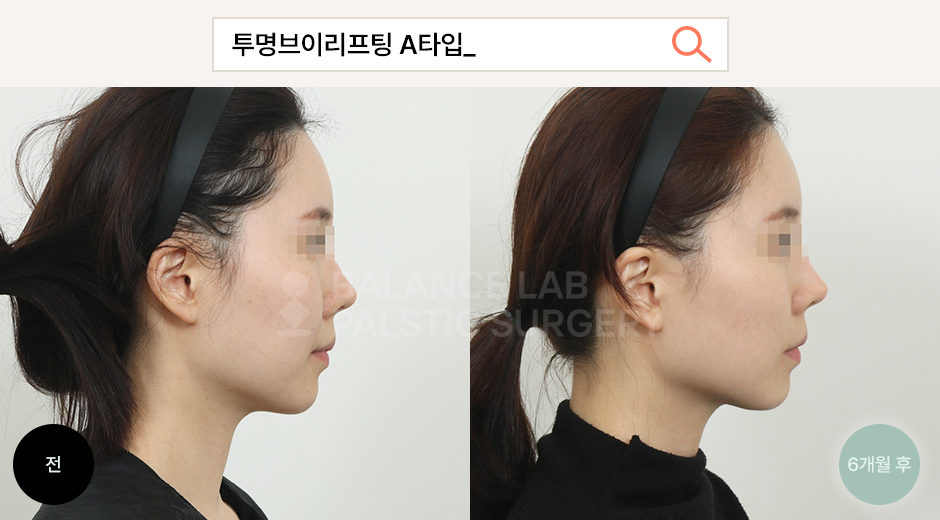 Before 2 Side